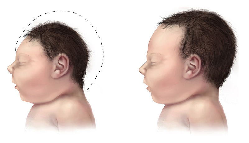 Microcephaly comparison. Image courtesy of US Centers for Disease Control